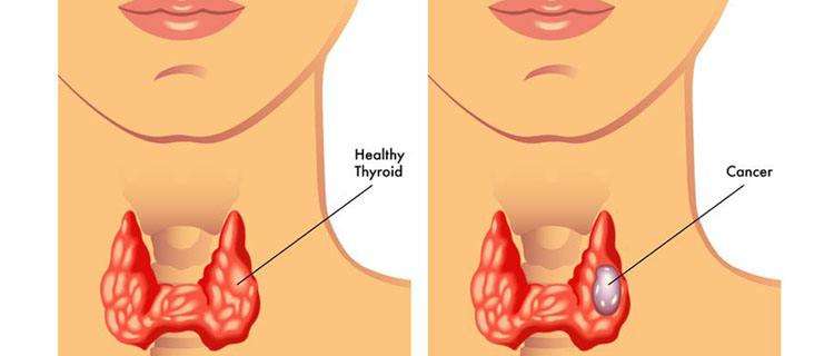 甲狀腺結節(jié)會癌變的幾種情況