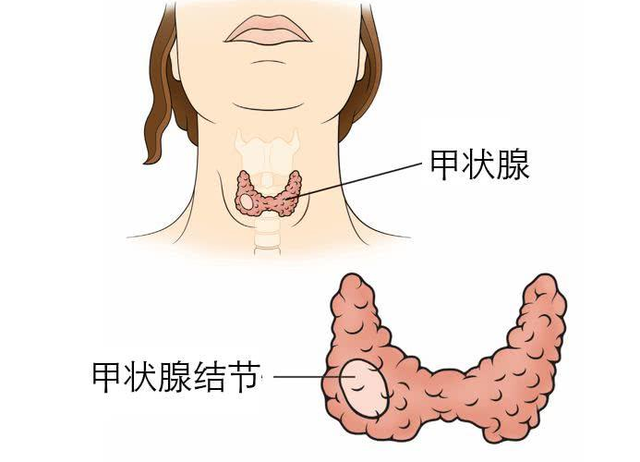 塞克陸德碘元素自動(dòng)檢測(cè)儀檢測(cè)甲狀腺結(jié)節(jié)的誘因